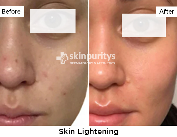 Skin Whitening results